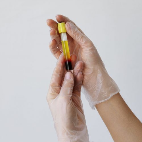 hands-holding-vial-prp-treatments